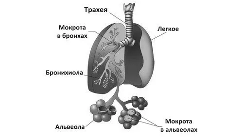 пневмонія