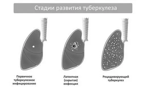 Відкрита форма туберкульозу: як передається, симптоми, лікування передається
