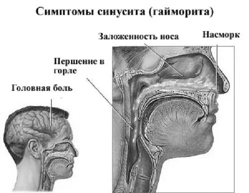 гострий