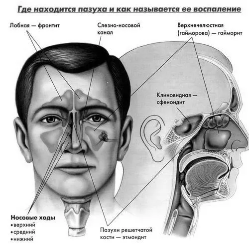 синусит