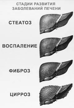 Стеатоз печінки (гепатоз) жировий гепатоз