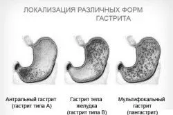 гастриті
