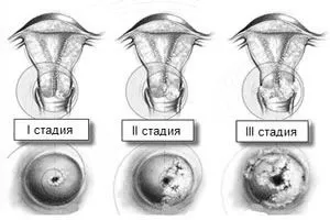 як лікувати рак матки