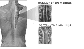 як лікувати розтягнення м'язів в домашніх умовах