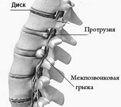 Спондильоз шийного відділу хребта: симптоми і методи боротьби симптоми