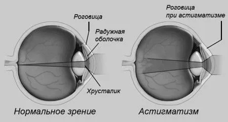 астигматизм