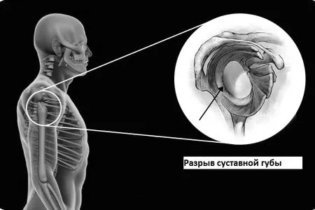 як лікувати розрив губи