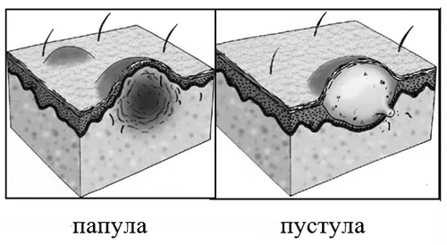 акне