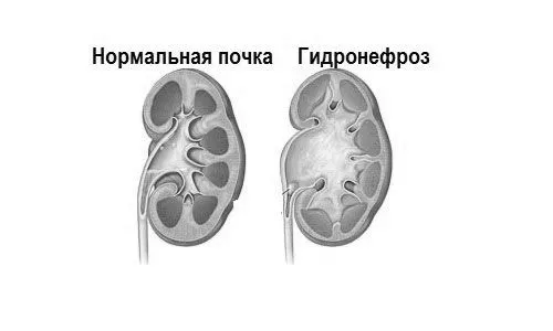 Розширення балії нирки у новонародженого (гідронефроз у грудничка) як лікувати гідронефроз нирки у новонародженого