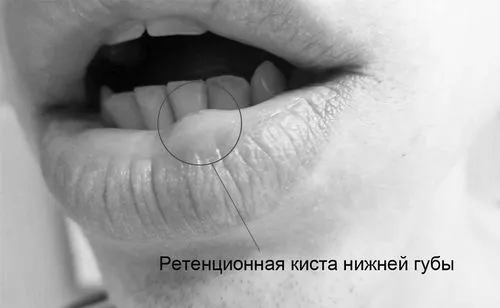 кіста на губі