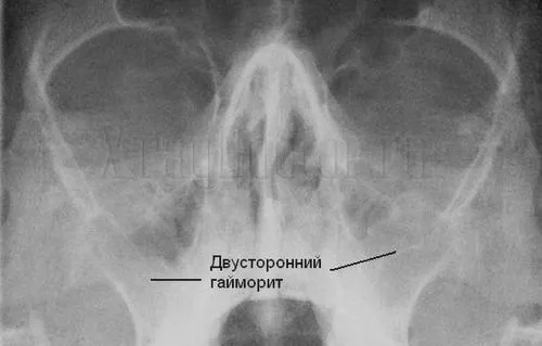 Рентген знімок гайморит рентген