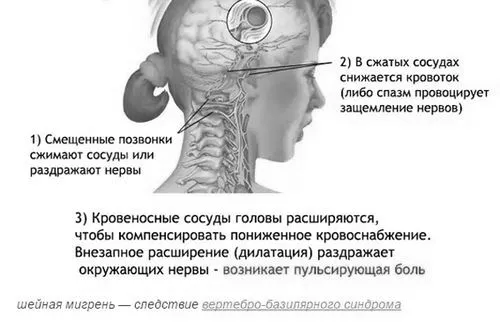 синдром
