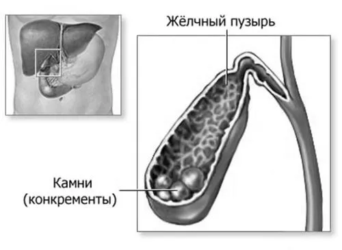 міхура