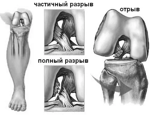 суглоба
