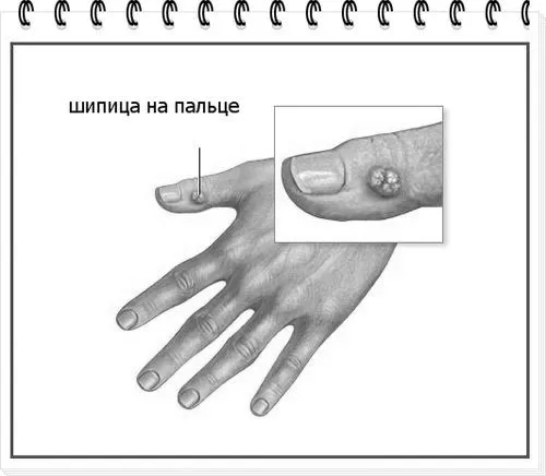 як можна вилікувати шіпіцу