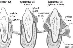 укол