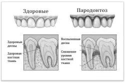 як лікувати ясна уколами