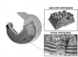 гастрит