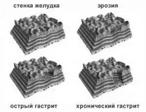 як лікувати виразковий гастрит