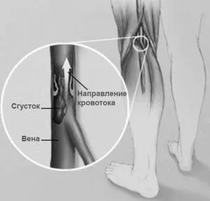 варикозне