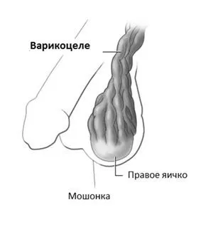 чи можна вилікувати варикоз 1 ступеня