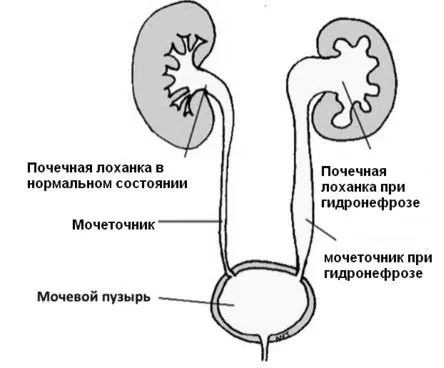 Запалення ниркової балії запалення