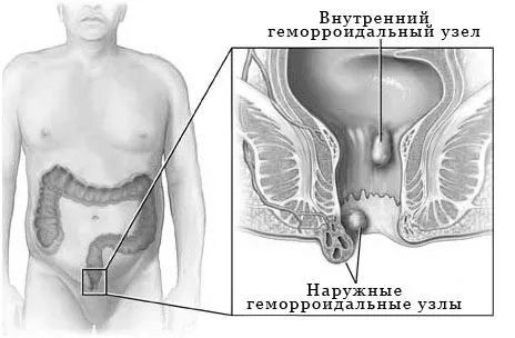 хронічний