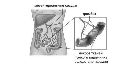 як лікувати тромбоз кишечника