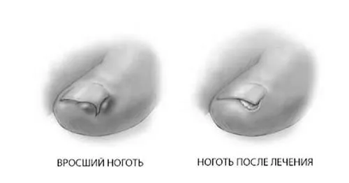 Врослий ніготь на нозі нозі