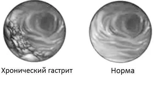 хронічний