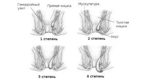 вилікувати хронічний геморой