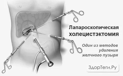 міхура