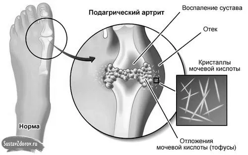 суглоба