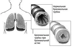 астма