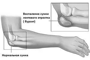 Бурсит ліктя: причини, симптоми ліктя