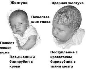 жовтяниця