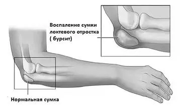 як лікувати бурсит в домашніх умовах