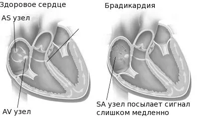 таблетки для лікування миготливої ​​аритмії