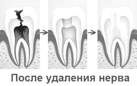 запалення