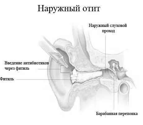 отиті