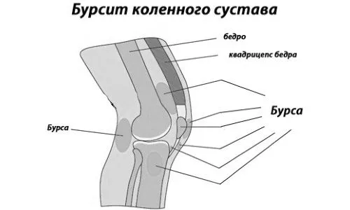 як вилікувати хронічний бурсит