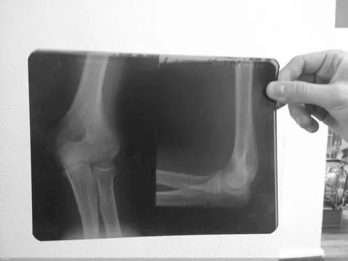 як лікувати ліктьовий суглоб