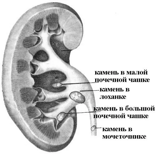 Болять нирки, що робити? що робити якщо болять нирки