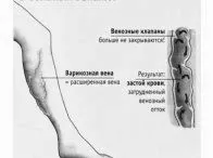 як вилікувати варикоз раз і назавжди