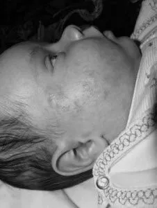 Діатез у немовлят: лікування як лікувати діатез під час вагітності