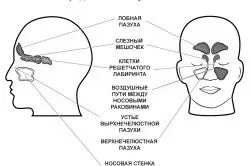 Що таке гайморит і чим він небезпечний лікування риніту