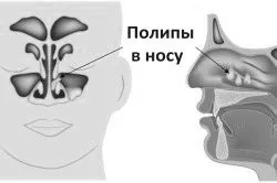 Що таке гайморит і чим він небезпечний небезпечний