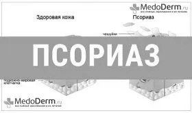 псоріаз