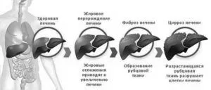 як лікувати цироз печінку