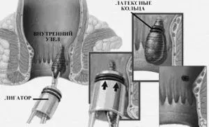 лікування геморойних шишок